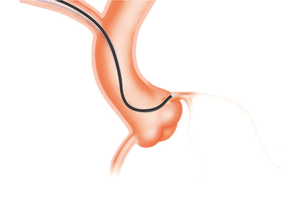 Guiding Catheter